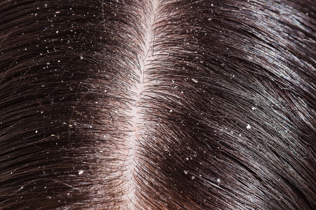 All About Dandruff | Saikia Skin Care