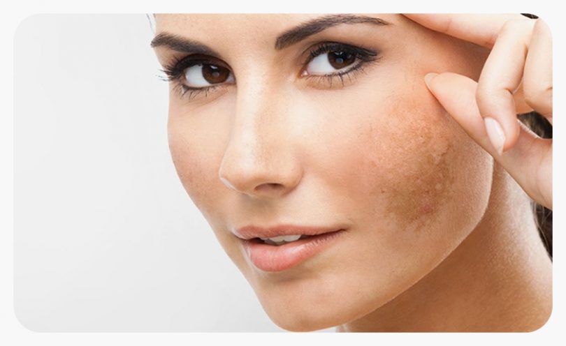 Why you should consult a Dermatologist for your skin problems!
