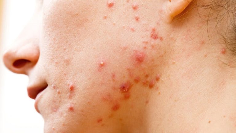 Acne-pimples-skin-treatment-gandhinagar