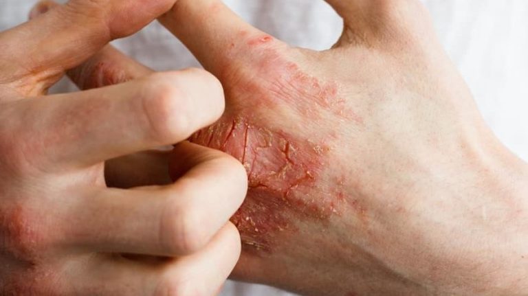 Eczema treatment kudasan gandhinagar allergy