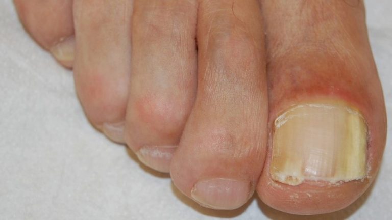 Fungal infection of nail onychomycosis gandhinagar