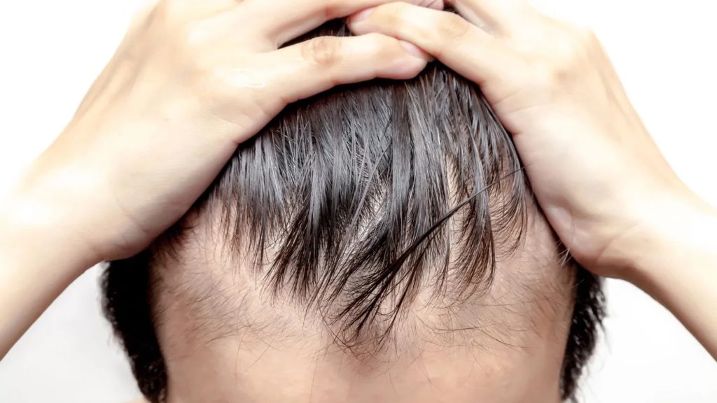 Hair loss baldness Hair Fall treatment gandhinagar