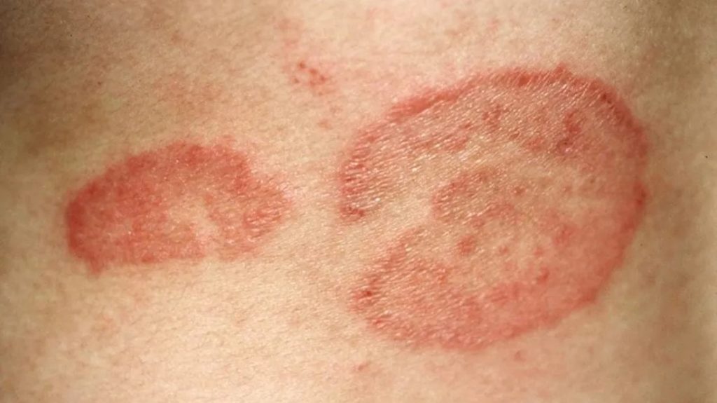 Pictures of common skin rashes, symptoms & treatments | GoHealth Urgent Care