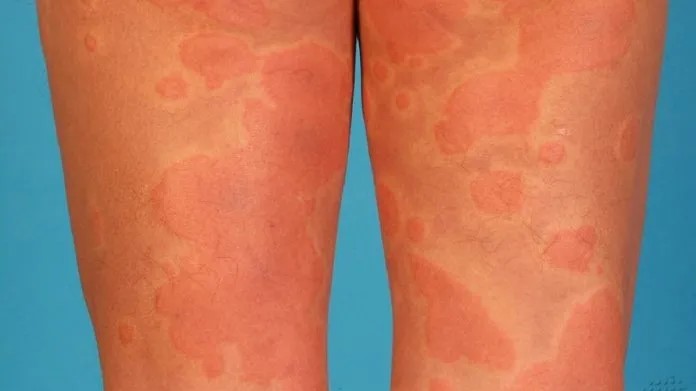 Urticaria allergy skin reaction treatment kudasan gandhinagar