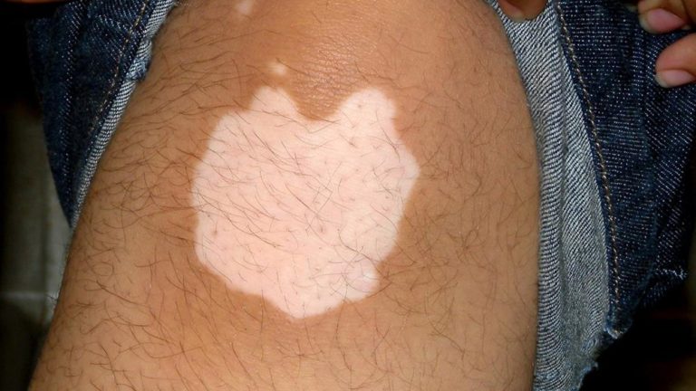 Vitiligo treatment kudasan gandhinagar best doctor