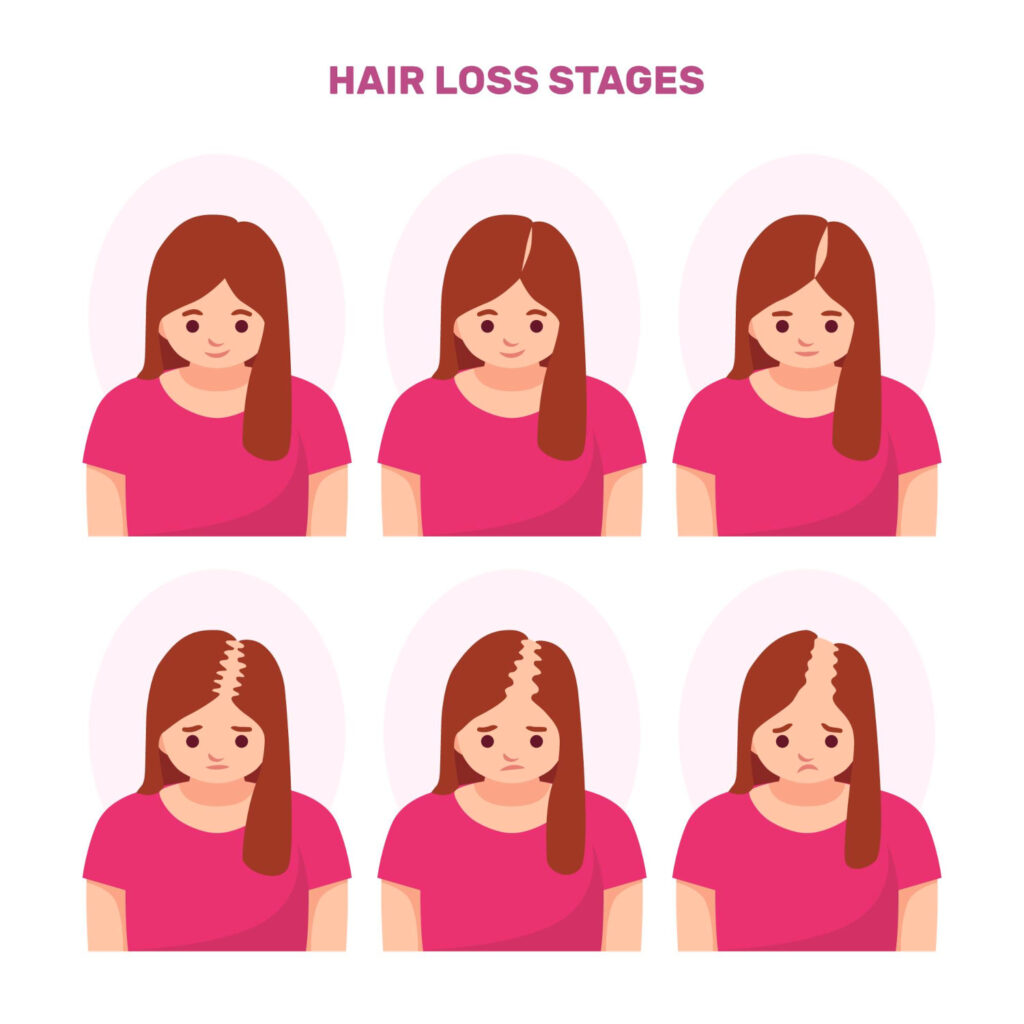 FPHL Hair loss in females